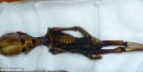 Alien-like Skeleton Turns Out to be Human